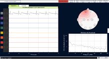 Screenshot of the OpenBCI Processing application displaying a basic electrocardiogram
