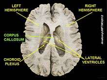  Corpus callosum